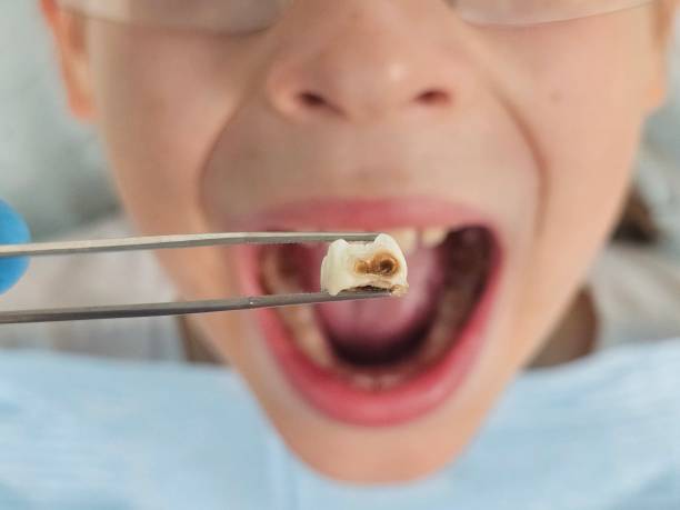 Best Knocked-Out Tooth (Avulsed Tooth) Treatment in Coson, OK